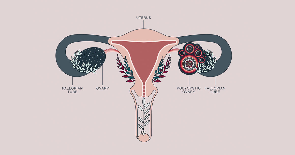 Blog Social Thumb Pcos