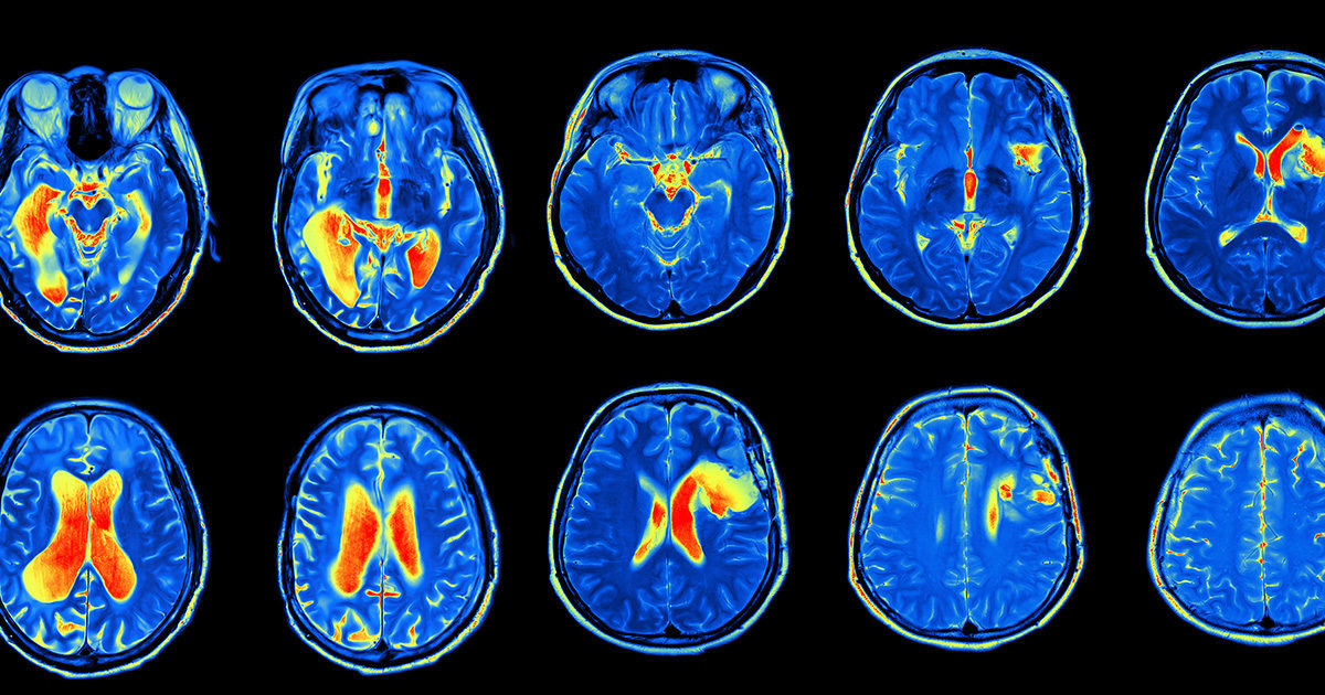 Blog Social Thumb Fmri