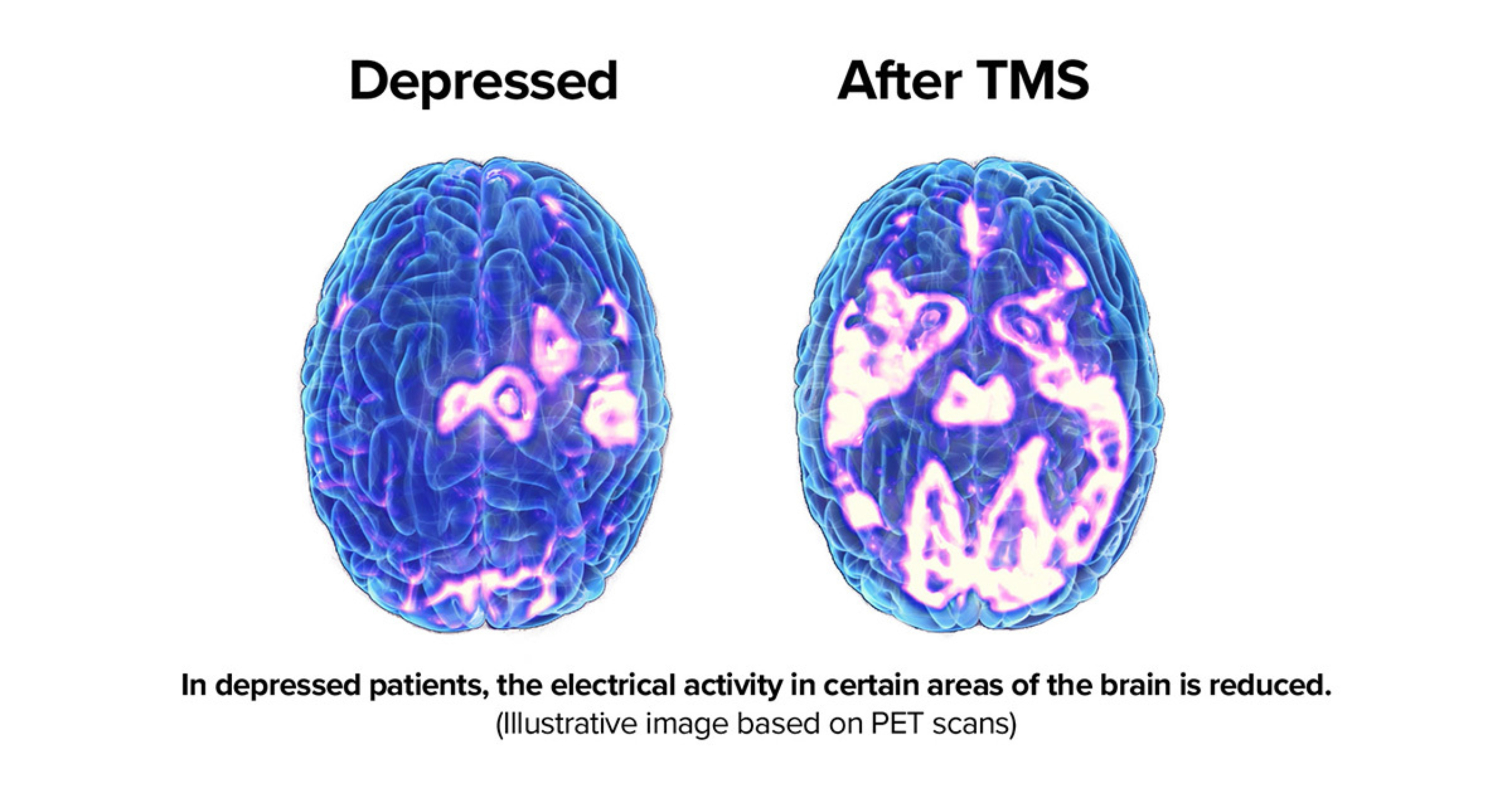 A comparative PET brain scan shows a brain on the left with much less electrical activity versus the image on the right which shows significantly more electrical activity after TMS treatment.