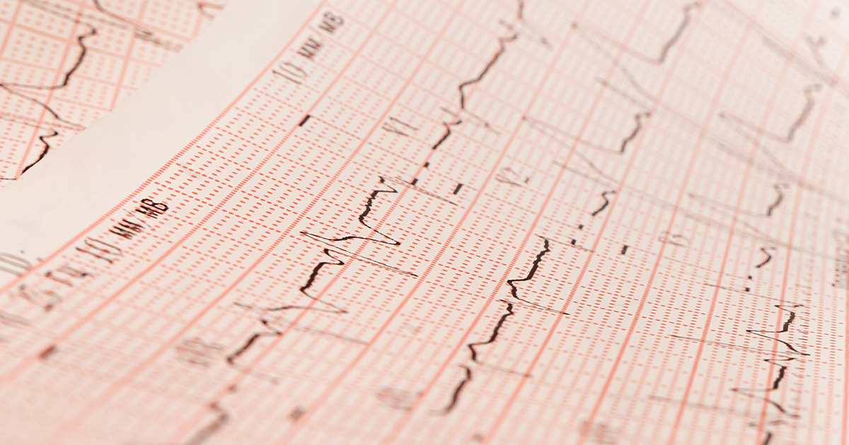 A close-up of an intracranial electrocorticography reading.