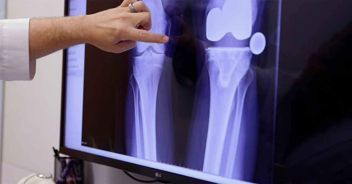 A hand pointing to an x-ray of a bone on a computer screen.