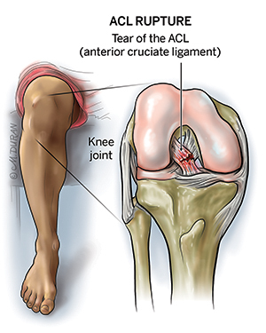 Illustration of a knee joint with an ACL tear labelled "ACL Rupture: Tear of the ACL(anterior cruciate ligament)". A drawing of a knee to the left provides context for the ACL's location in the body.