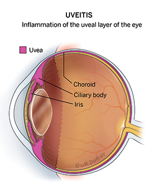 Cross-section illustration of the eye labeled "Uveitis: inflammation of the uveal layer of the eye". The uvea is colored in pink at the front of the eye near the iris, which is labelled, as are the nearby ciliary body and choroid layer of the eye.