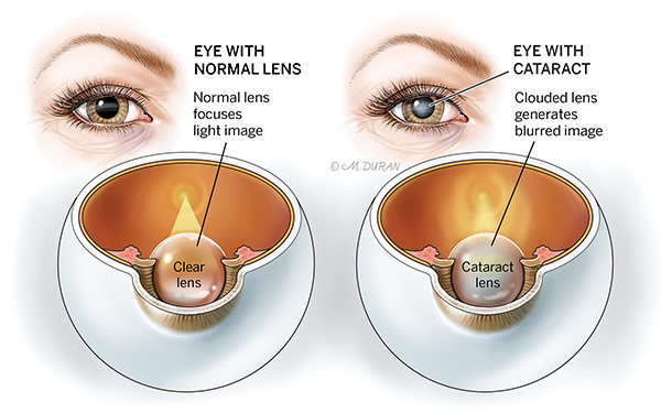 Two illustrated cross sections demonstrating how light passes through an eye with a clear lens compared to an eye with a cataract lens. The eye without cataract is labelled "Eye with normal lens: Normal lens focuses light image". The eye with a cataract is labeled "Eye with cataract: Clouded lens generates blurred image." Next to each cross-section is an illustration of how each that eye would appear on a woman's face, with the cataract adding a clouded appearance to the eye.