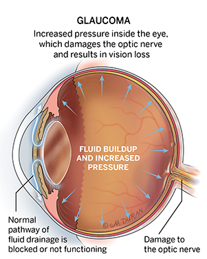 Cross-section illustration of the eye labelled "Glaucoma: Increased pressure inside the eye, which damages the optic nerve and results in vision loss." Towards the front of the eye is a label which reads "Normal pathway of fluid drainage is blocked or not functioning", "Fluid buildup and increased pressure" is labelled inside the eye, and the optic nerve leading out of the eye is labelled "Damage to the optic nerve"