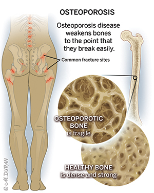 Comparison of osteoporotic and healthy bone tissue labelled "Osteoporosis: Osteoporosis disease weakens bones to the point that they break easily". The osteoporotic tissue is labelled "Osteoporotic bone is fragile", while the healthy bone tissue is labelled "Healthy bone is dense and strong." To the left is a diagram of common fracture sites on the body, with many points on the hip and spine marked in red.