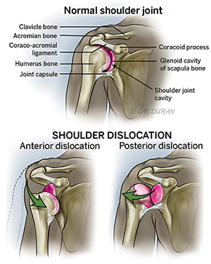 Illustration of a normal shoulder joint from the front with the following structures labelled: clavicle bone, acromian bone, coraco-acromial ligament, humerus bone, joint capsule, coracoid process, glenoid cavity of scapula bone, and shoulder joint cavity. Beneath are illustrations of two forms of shoulder dislocation: anterior (forward) dislocation and posterior (backward) dislocation.