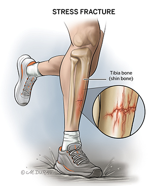 Drawing of a runners legs with an illustrated stress fracture of the tibia overlaid on the shin.