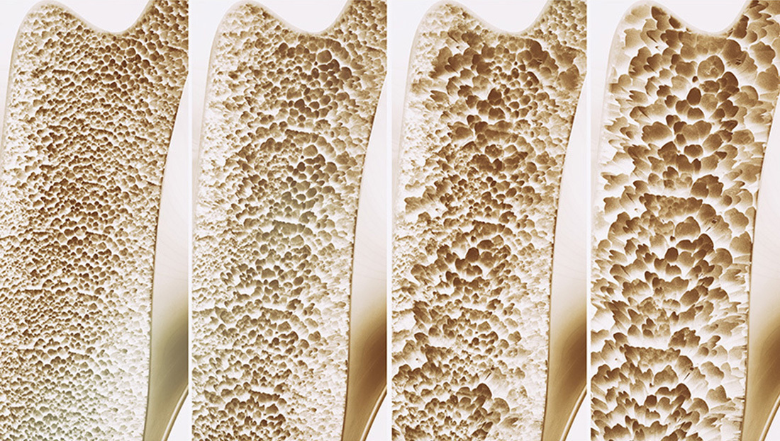 Four samples of bone are displayed, ranging from healthy bone on the left to bone with osteoporosis on the right.